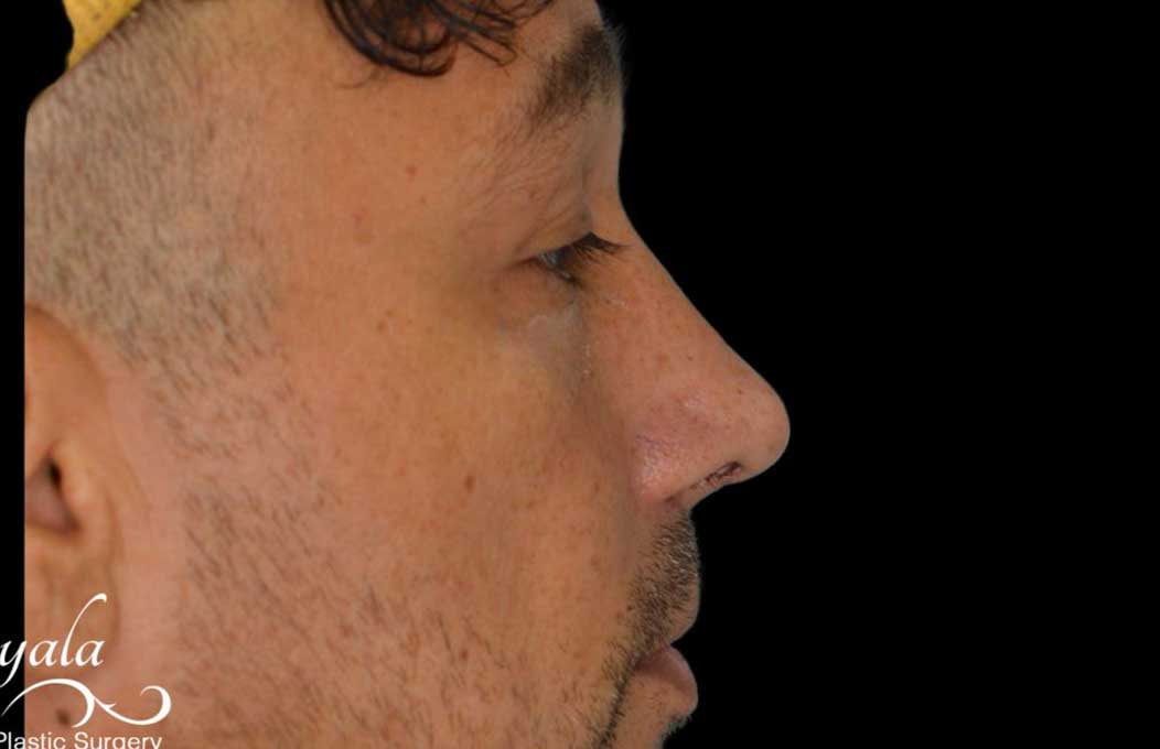 Rhinoplasty Case 53 – After
