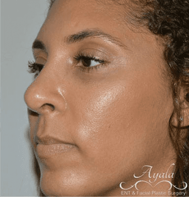 Rhinoplasty Case 3 – After