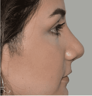 Rhinoplasty Case 8 – After