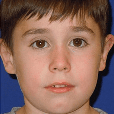 Ear Surgery Case 2 – After