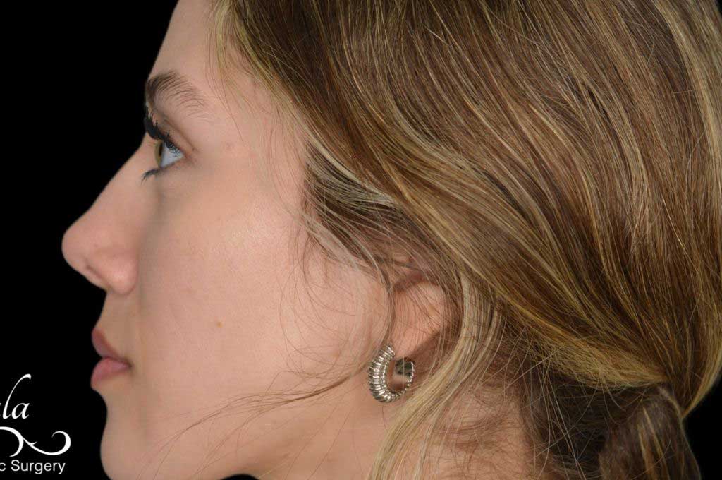 Rhinoplasty Case 43 – After