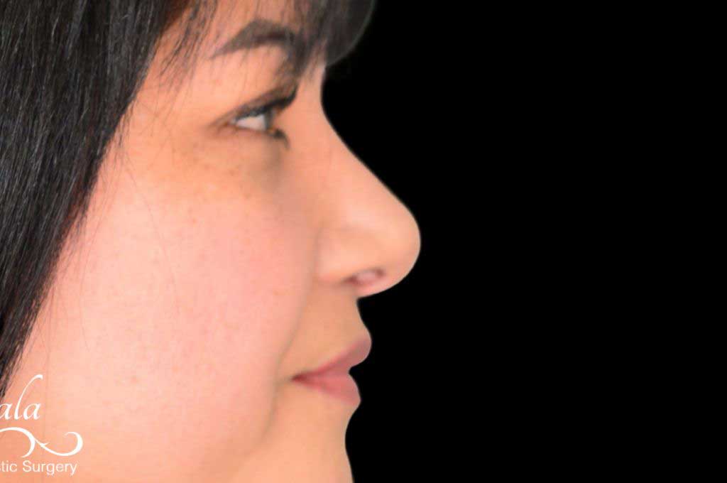 Rhinoplasty Case 44 – After