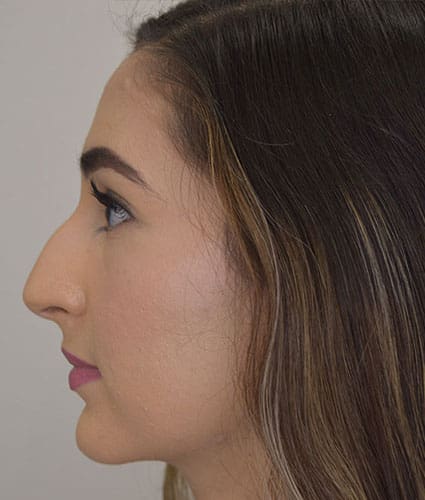 Rhinoplasty Case 26 – Before