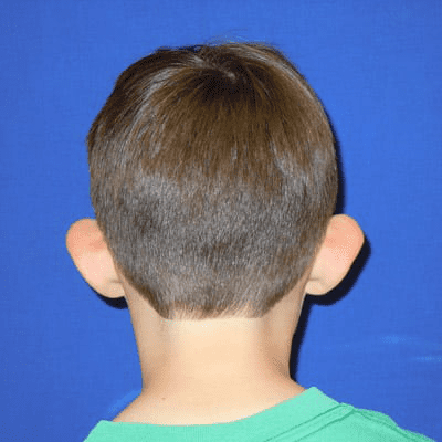 Ear Surgery Case 2 – Before