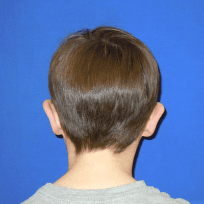 Ear Surgery Case 2 – After